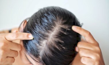 خبير أمراض جلدية: الإفراط في غسل الشعر يسبب جفاف فروة الرأس وتقصفه