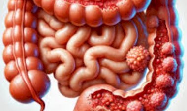 مضاعفات التهاب القولون التقرّحي.. مخاطر يجب الانتباه لها