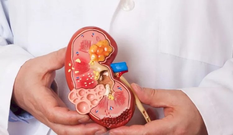 لو مريض كلى.. اعرف ضوابط الصيام خلال شهر رمضان