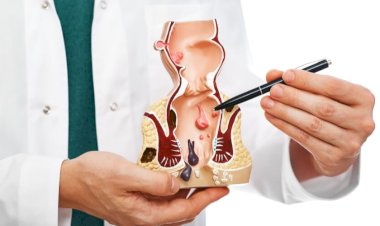 تسبب متاعب متعددة .. اكتشف أسباب البواسير ومضاعفاتها